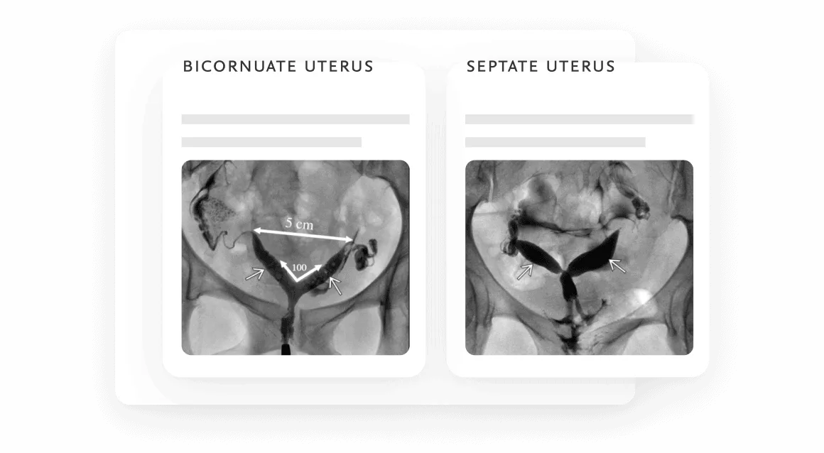 X-ray photographs of a bicornate uterus and a septate uterus